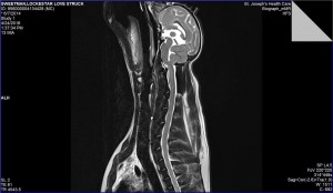 arrow MRI