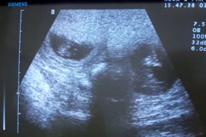 cavalier ultrasound